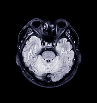 MRI of the brain Axial T2 flair view for detect a variety of conditions of the brain such as cysts, tumors, bleeding isolated on black backgroud , bleeding . Clipping path.