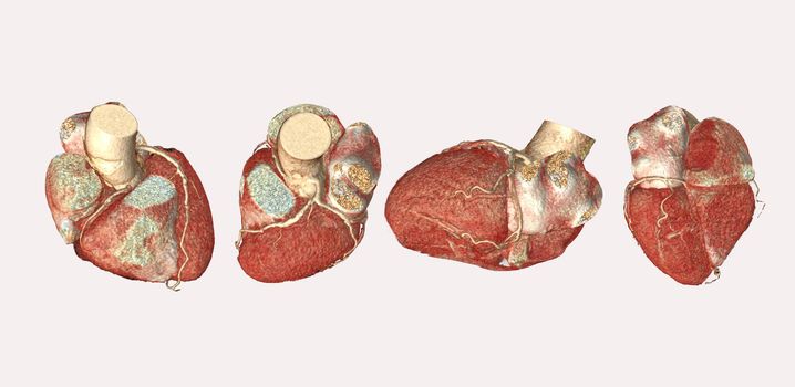 Collection of CTA Coronary artery 3D rendering image isolated o white backgroud for finding coronary artery disease.Clippig path.