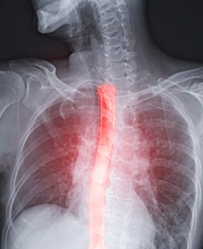 Esophagram or Barium swallow image showing Esophageal stent placement for patient Esophageal cancer.