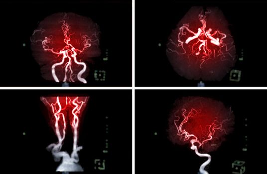 Compare of MRA Brain or Magnetic resonance angiography ( MRA ) of cerebral artery and common carotid artery AP and Lateral View for evaluate them stenosis and stroke disease.