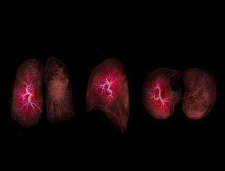 Selective focus of CT Chest or Lung 3D rendering image for diagnosis lung diseases ,TB or tuberculosis and covid-19 .