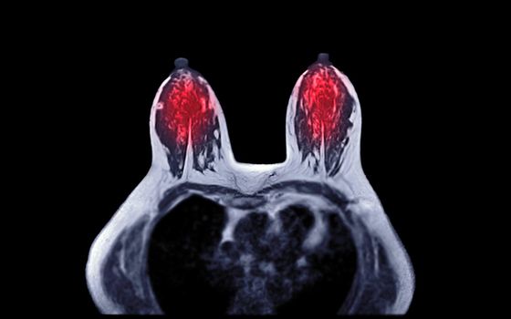 Breast MRI or magnetic resonance imaging axial T1W of Breast in women for screening breast cancer.