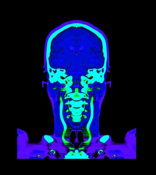 Collection colorful of CT angiography of the brain or CTA brain comparison Coronal view . Clipping path.