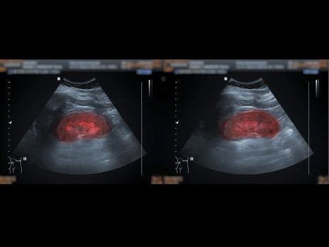 Ultrasound upper abdomen showing kidney for screening renal disease.