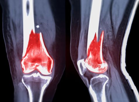 CT knee joint Coronal and Sagittal view isolated on black background showing fracture Femur bone.