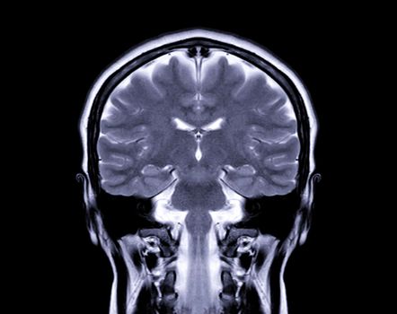 MRI Brain Coronal t2W view for detect a variety of conditions of the brain such as cysts, tumors, bleeding isolated on the screen.