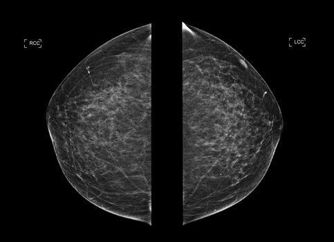 X-ray Digital Mammogram or mammography both side of the breast CC view for diagnonsis Breast cancer in women