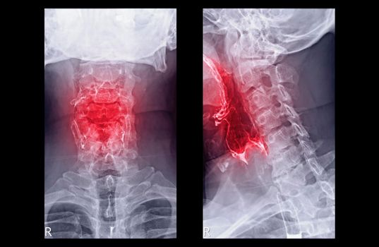 Esophagram or Barium swallow AP and Lateral view showing esophagus for diagnosis GERD or Gastroesophageal reflux disease and Esophageal cancer.