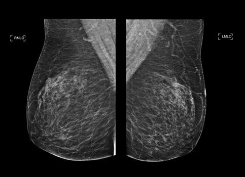 X-ray Digital Mammogram or mammography both side of the breast CC view for diagnonsis Breast cancer in women