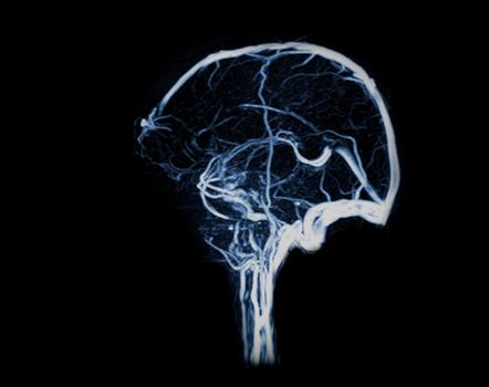 MRV Brain or magnetic resonance venography of The Brain for abnormalities in venous drainage of the brain sagittal view.