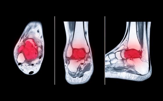 Compare of MRI ankle axial, coronal and sagittal PDW view showing bone metastasis to the talus.