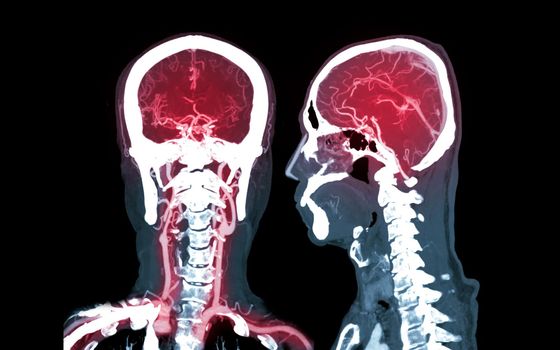 Collection of CTA brain or CT angiography of the brain comparison Mip technique Coronal and Sagittal view for detect brain anueurym.