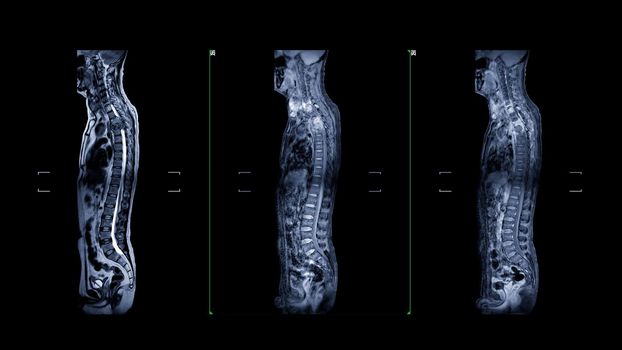 MRI of whole spine T2W , T1FS and T1FS with Gadolnilum contrast sagittal plane for diagnostic Spinal Cord Compression.