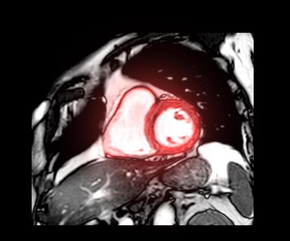 MRI heart or Cardiac MRI ( magnetic resonance imaging ) of heart short axis view for diagnosis heart disease.