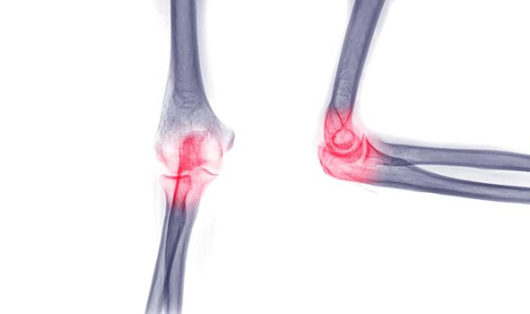 X-ray Elbow or Radiography of Right elbow AP and Lateral view for diagnostic fracture of elbow.