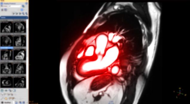 MRI heart or Cardiac MRI magnetic resonance imaging of heart in Sagittal view showing cross-sections of the left and right ventricle for detecting heart disease on blurred monitor.