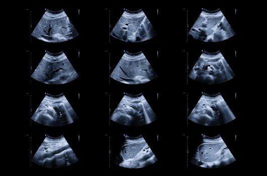 Ultrasound upper abdomen showing Liver and gall bladder for screening hepatic cell carcinoma and gallstone.