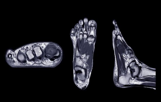 Manetic resonance imaging of foot or MRI FOOT PDW axial, Coronal and sagittal view for diagnostic tendon injury.