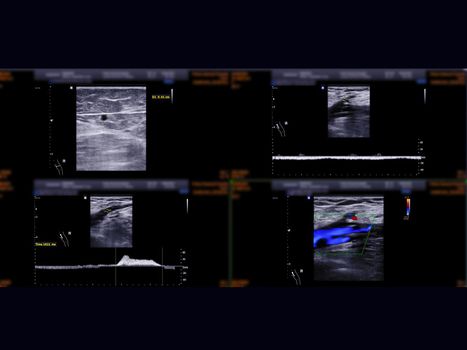 Ultrasound doppler for diagnosis deep vein thrombosis disease of lower extremity or DVT.