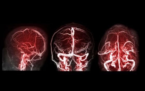 MRV Brain or magnetic resonance venography of The Brain for abnormalities in venous drainage of the brain