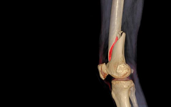 CT knee 3D rendering image Lateral view isolated on black background showing fracture Femur bone.