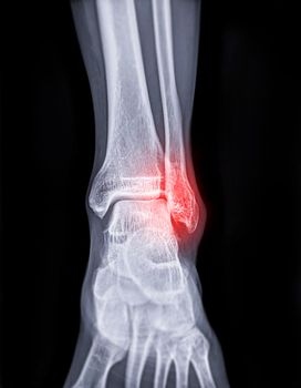 X-ray image of ankle joint showing fracture of ankle joint..