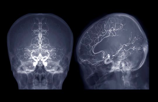 Cerebral angiography AP and Lateral view image from Fluoroscopy in intervention radiology showing cerebral artery.