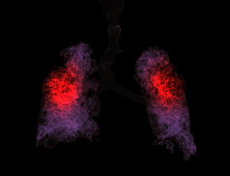CT Chest 3d rendering showing lung infection from covid-19.