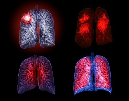 Collection of CT Chest or Lung 3D rendering image on the monitor for diagnosis TB,tuberculosis and covid-19 .