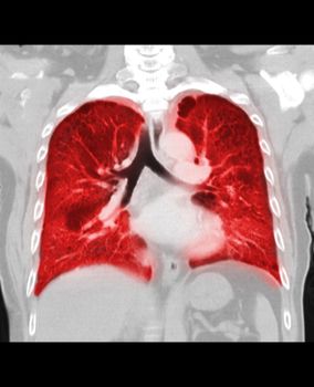 CT scan of Chest or lung coronal view of lung infection covid-19 with ground glass opacity isolated on black background.