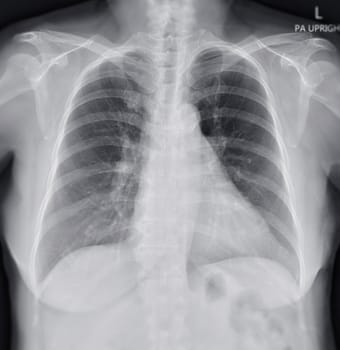 Chest x-ray image for screening diagnosis TB,tuberculosis and covid-19.