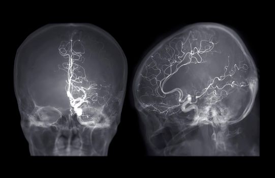 Cerebral angiography AP and Lateral view image from Fluoroscopy in intervention radiology showing cerebral artery.