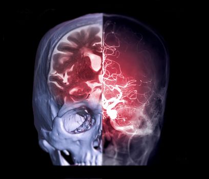 Fusion image of CT MRI brain and Cerebral angiography image front view showing anatomical of the brain and cerebral artery.