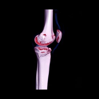 CT knee joint 3D rendering image showing fracture tibia bone