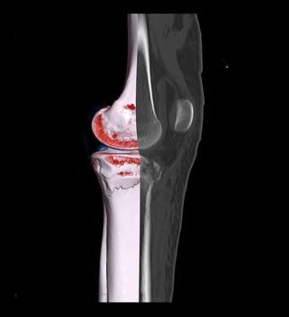 Compare of CT knee joint 3D rendering image and CT knee 2D isolated on black background showing fracture tibia bone.