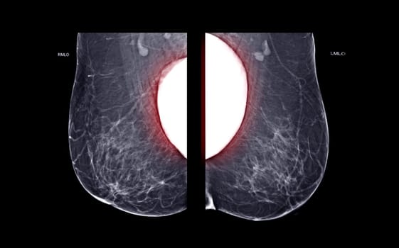 X-ray Digital Mammogram or mammography both side of the breast MLO view with Breast Implants for diagnonsis Breast cancer in women isolated on black background.