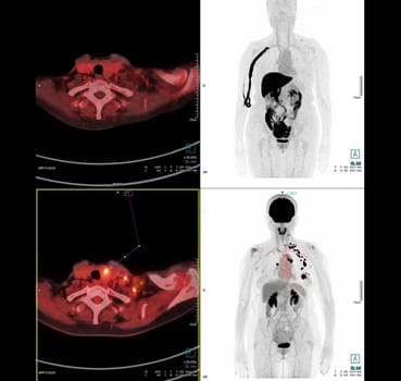 PET Scan image of thorax or chest Comparison Axial , Coronal for detect lung cancer recurrence after surgery. medical technology concept.