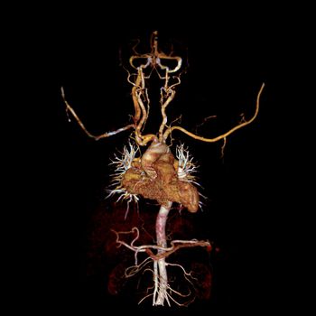 CTA thoracic aorta include common carotid artery 3D rendering image showing cardiovascular system.