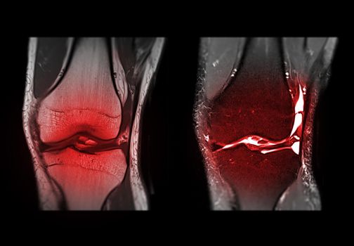 Magnetic resonance imaging of the knee or MRI knee coronal view for detect tear or sprain of the anterior cruciate ligament (ACL).