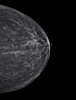 X-ray Digital Mammogram or mammography at left side of the breast CC view for diagnonsis Breast cancer in women isolated on black background.