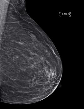 X-ray Digital Mammogram or mammography at left side of the breast MLO view for diagnonsis Breast cancer in women isolated on black background.