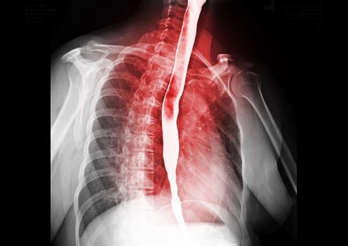 Esophagram or Barium swallow showing esophagus for diagnosis GERD or Gastroesophageal reflux disease or Esophageal cancer.