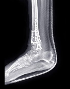 X-ray image of ankle joint showing surgical treatment by internal fixation with plate and screw.