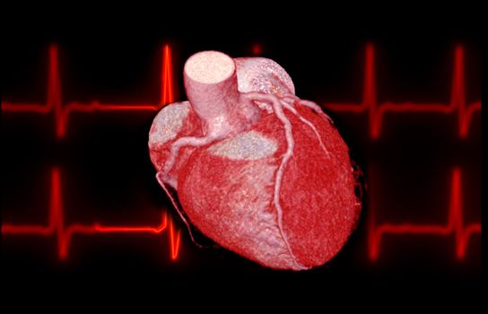 CTA Coronary artery 3D rendering image on the screen for diagnosis of vessel coronary artery stenosis .