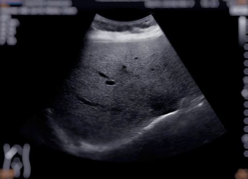 Ultrasound upper abdomen showing Liver and gall bladder for screening hepatic cell carcinoma and gallstone.