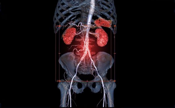 CTA Whole Aorta 3D rendering image of the arteries in the whole body with abdominal aorta stent graft generate from CT scanner