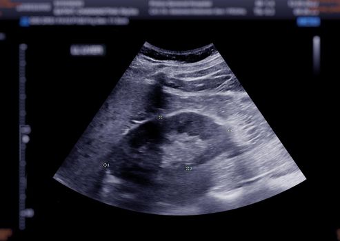 Ultrasound upper abdomen showing kidney.