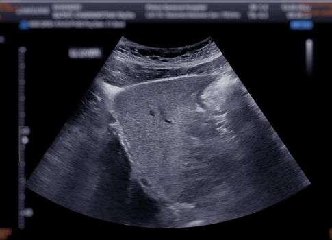 Ultrasound upper abdomen showing liver.