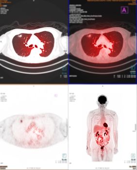 PET Scan image of thorax or chest Comparison Axial , Coronal for detect lung cancer recurrence after surgery. medical technology concept.