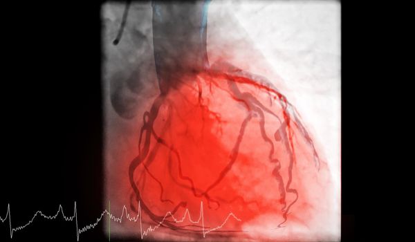 Cardiac catheterization is a test used to find out cardiac arrest .